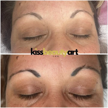 Tetoválás eltávolítás