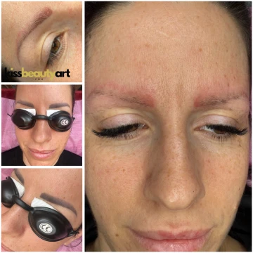 Tetoválás eltávolítás